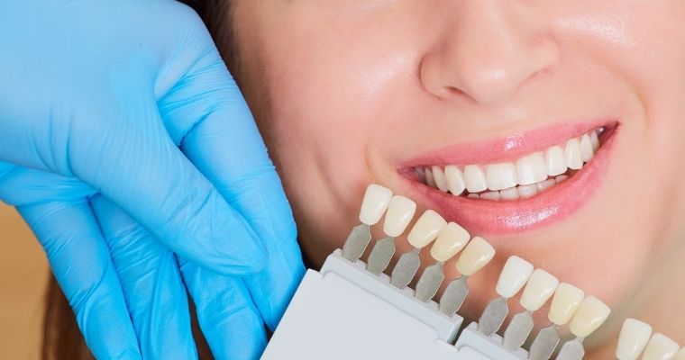 Teeth Whitening FAQs: How to Prepare, How Long It Lasts, and More!