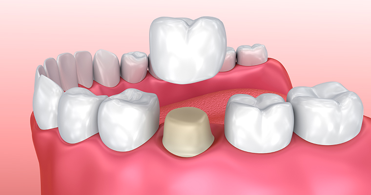 How Long Do CEREC Same-Day Crowns Last?